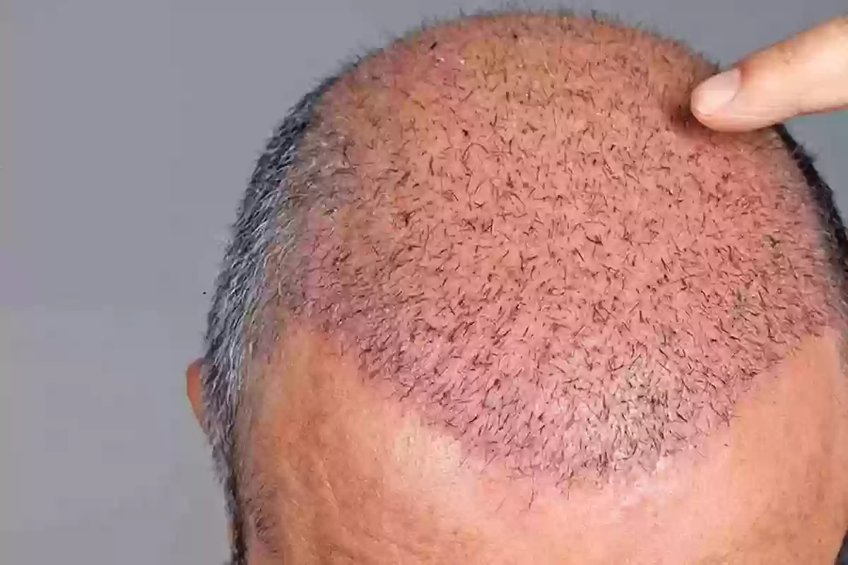 تكلفة زراعة الشعر في السعودية بالريال وأفضل المراكز المتخصصة