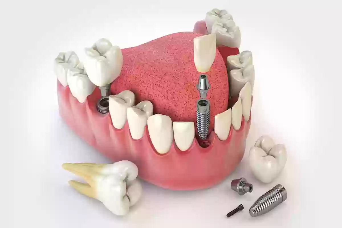 أفضل مراكز زراعة الاسنان في الرياض